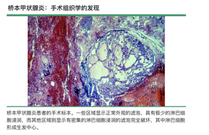 功医案例解析：三个月逆转桥本甲状腺炎！