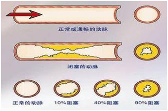 功医案例解析：三个月逆转颈动脉斑块！