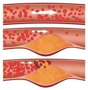 动脉粥样硬化斑块的8大危险因素